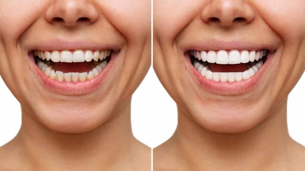 Before and after teeth whitening results. Oxford