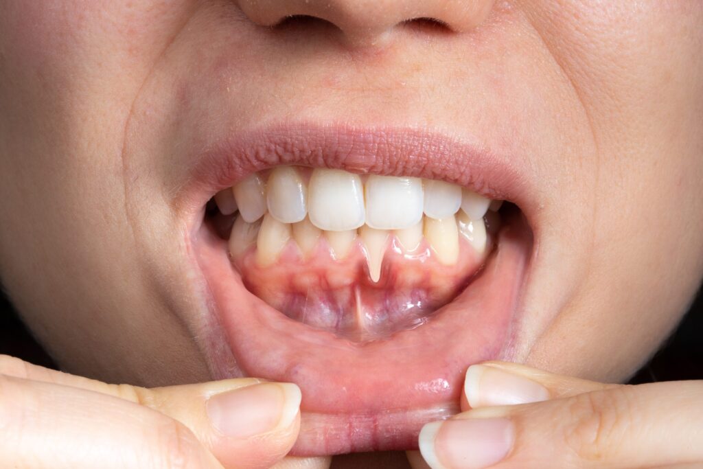 Preparing for teeth whitening with receding gums Oxford